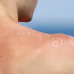 5 Tips Mengatasi Kulit Belang Akibat Paparan Sinar Matahari