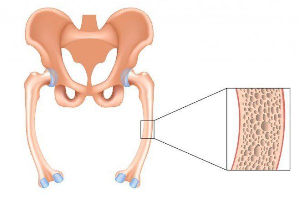5 Langkah Mencegah Osteomalasia Secara Efektif 5 Langkah Mencegah Osteomalasia Secara Efektif
