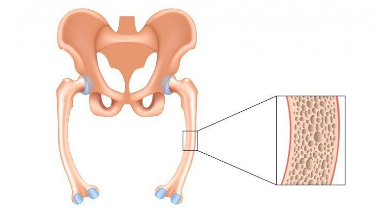 5 Langkah Mencegah Osteomalasia Secara Efektif