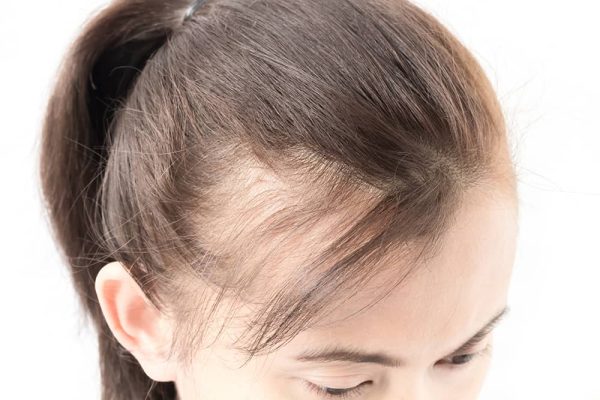 10 Tips Mencegah Kerontokan Rambut di Usia Muda