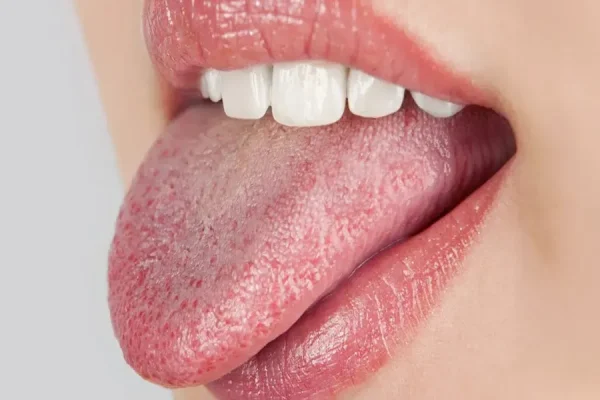 5 Cara Merawat Lidah Bagi Penderita Diabetes 5 Cara Merawat Lidah Bagi Penderita Diabetes