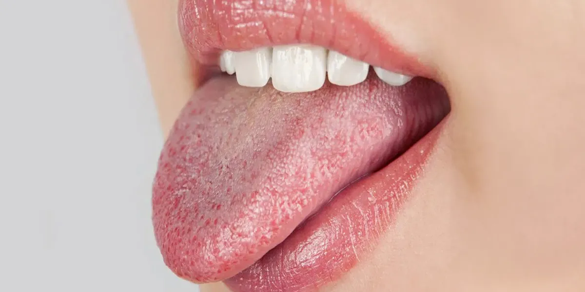5 Cara Merawat Lidah Bagi Penderita Diabetes