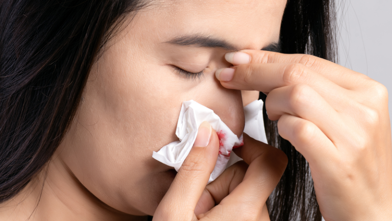 7 Cara Merawat Hidung yang Sering Mimisan