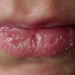 5 Cara Menghilangkan Kulit Mati di Bibir Tanpa Iritasi