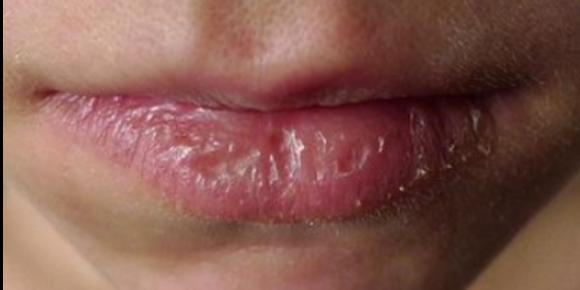 5 Cara Menghilangkan Kulit Mati di Bibir Tanpa Iritasi